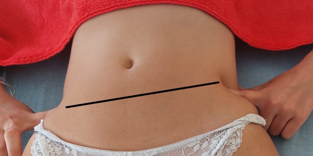 Korrektur Beckenschiefstand